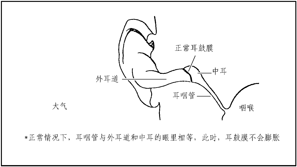 三、中耳氣壓性損傷(Otic Barotrauma)